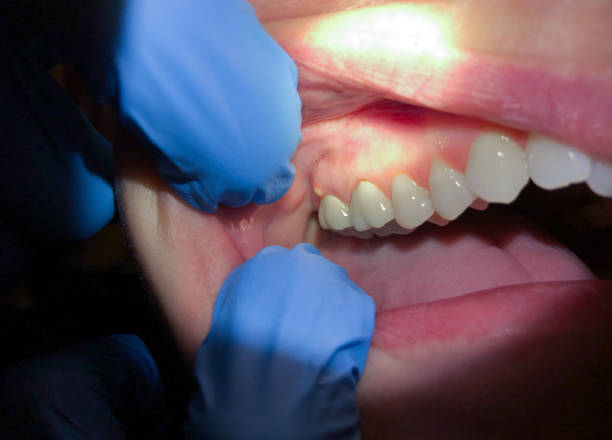 Best Emergency Treatment for Dental Infections or Abscesses in Mcloud, OK