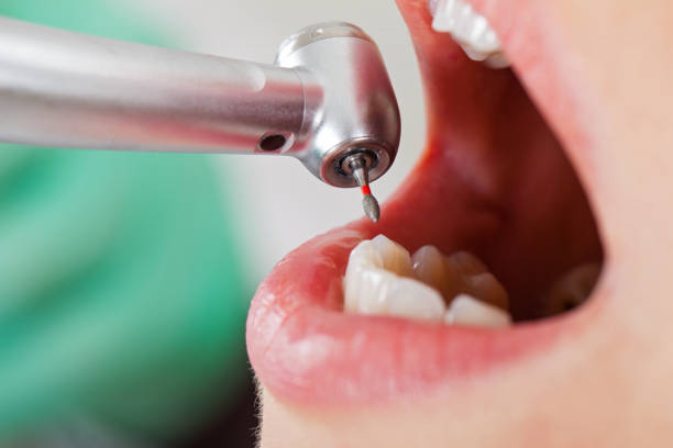 Best Emergency Dental Care for Broken or Chipped Teeth in Mcloud, OK